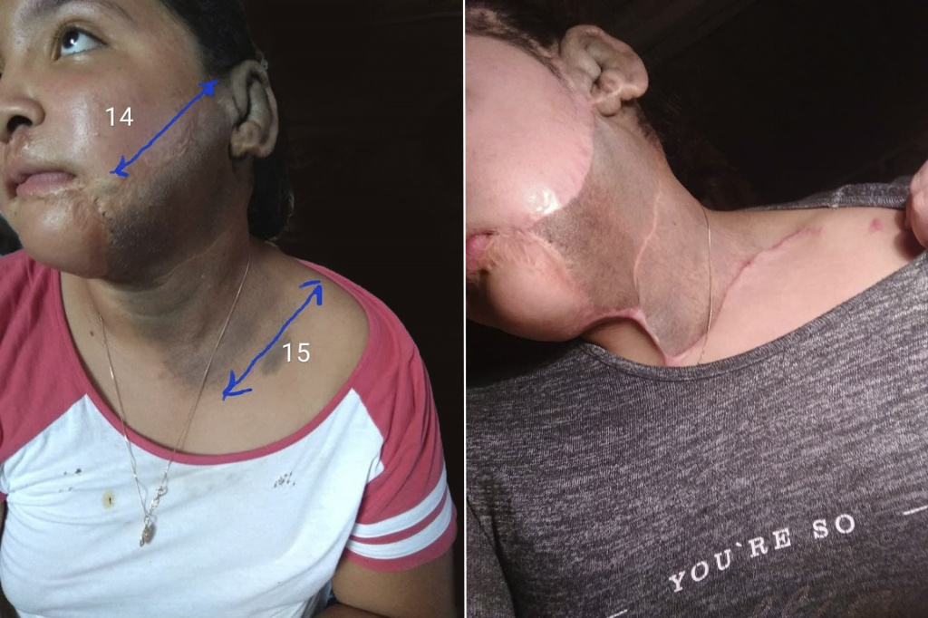 До и после первого этапа операции по иссечению невуса